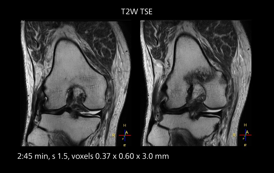 Knee mri one