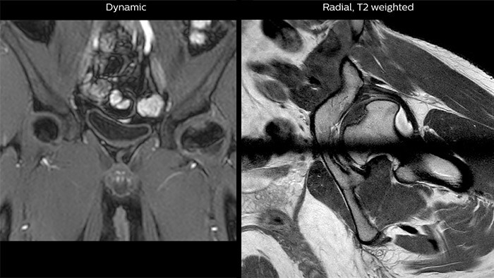 Perthes disease in left hip