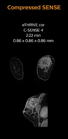 clinical image breast compressed sense 2