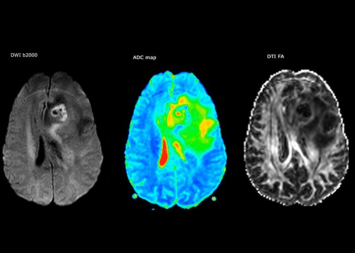 diffusion imaging