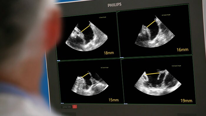 EPIQ CVxi interventional ultrasound system