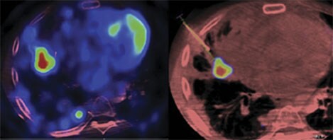 xperguide ablation